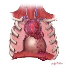 Thymus Cancer Treatment