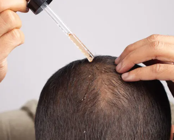 Topical Hair Loss Treatments