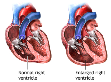 Tricuspid Regurgitation