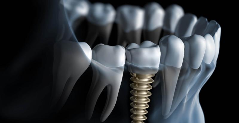 Next Generation Implants (NGI)