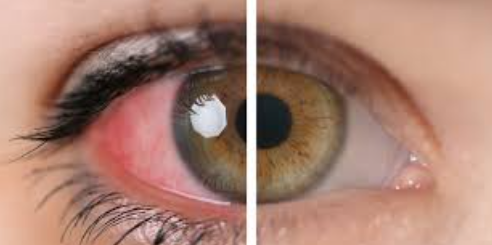 Uveitis Treatment Drug