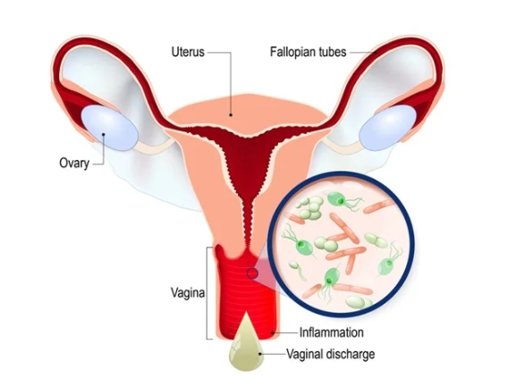 Vaginitis Diagnostics