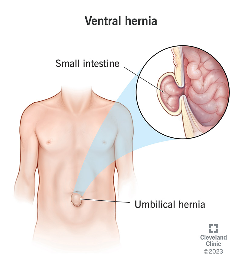 Ventral Hernia Treatment