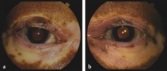 Vogt-Koyanagi-Harada Syndrome