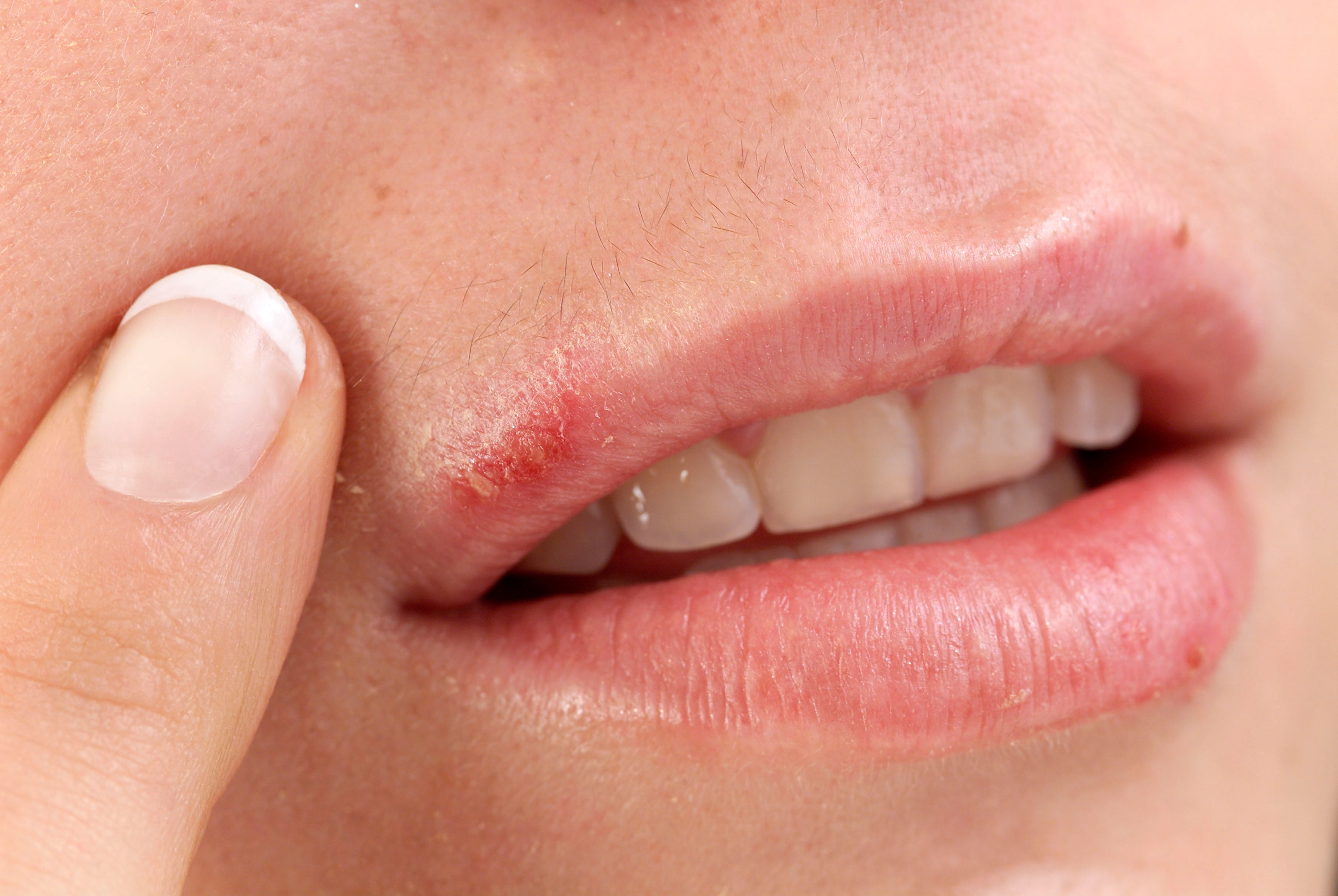 Cold Sore Antiviral Drug