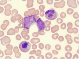 Myelodysplastic Syndrome