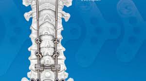 Posterior Occipital Cervical Thoracic Fixation System