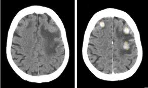 Non-ionic Monomeric Contrast Medium