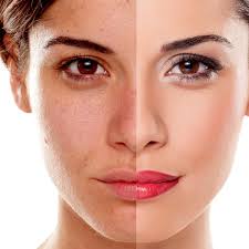 Hyperpigmentation Treatment