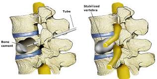 Vertebroplasty & Kyphoplasty