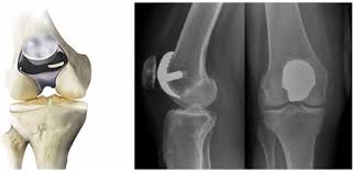 Patellofemoral Prosthesis