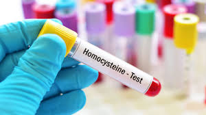 Homocysteine Testing