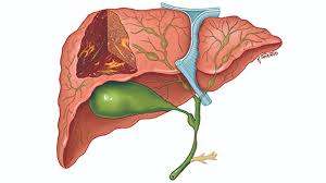 Hepatocellular Carcinoma Treatment Drug