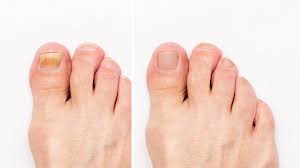 Fungal Nail Infections Treatment Drug