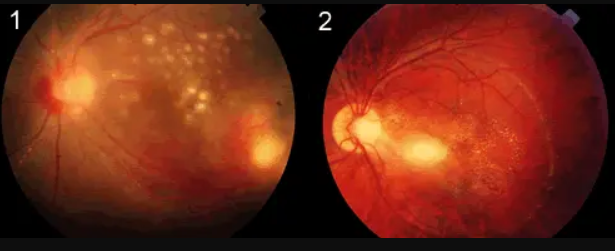 lnfectious Uveitis Treatment