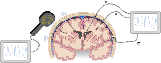 Intracranial Pressure Monitoring Devices