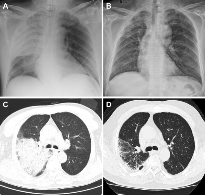 Acinetobacter Pneumonia Therapeutics