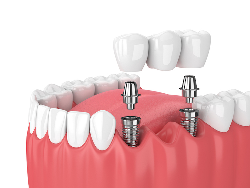 Dental Implant And Abutment