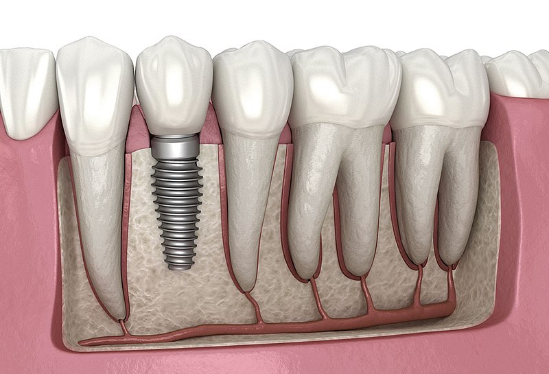 Dental Implant Prosthetic