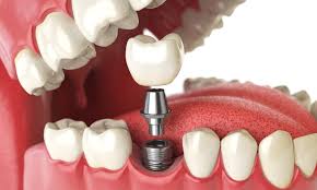 Dental Implants