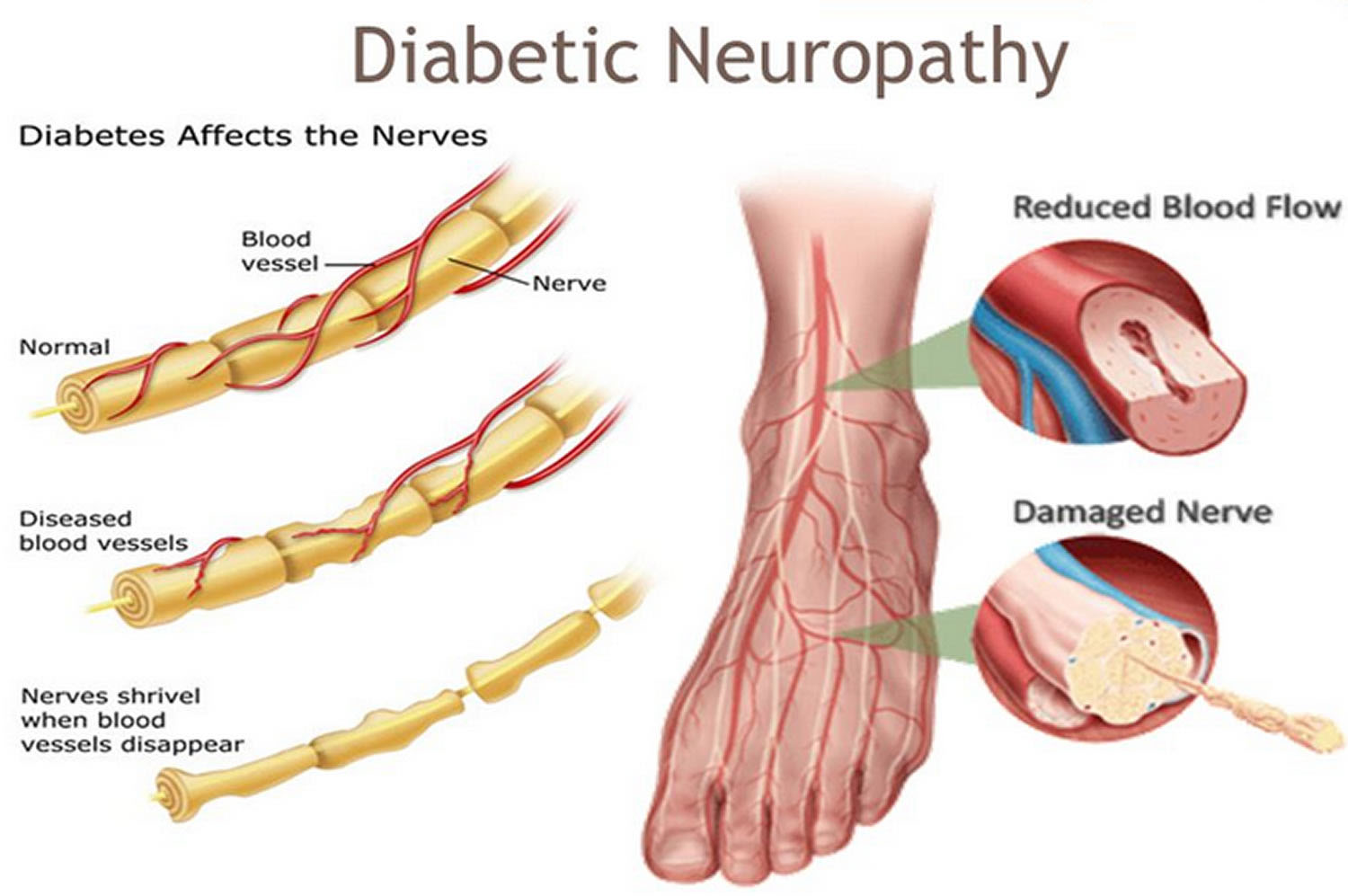 Diabetic Neuropathy Treatment