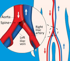 Iliac Vein Stent