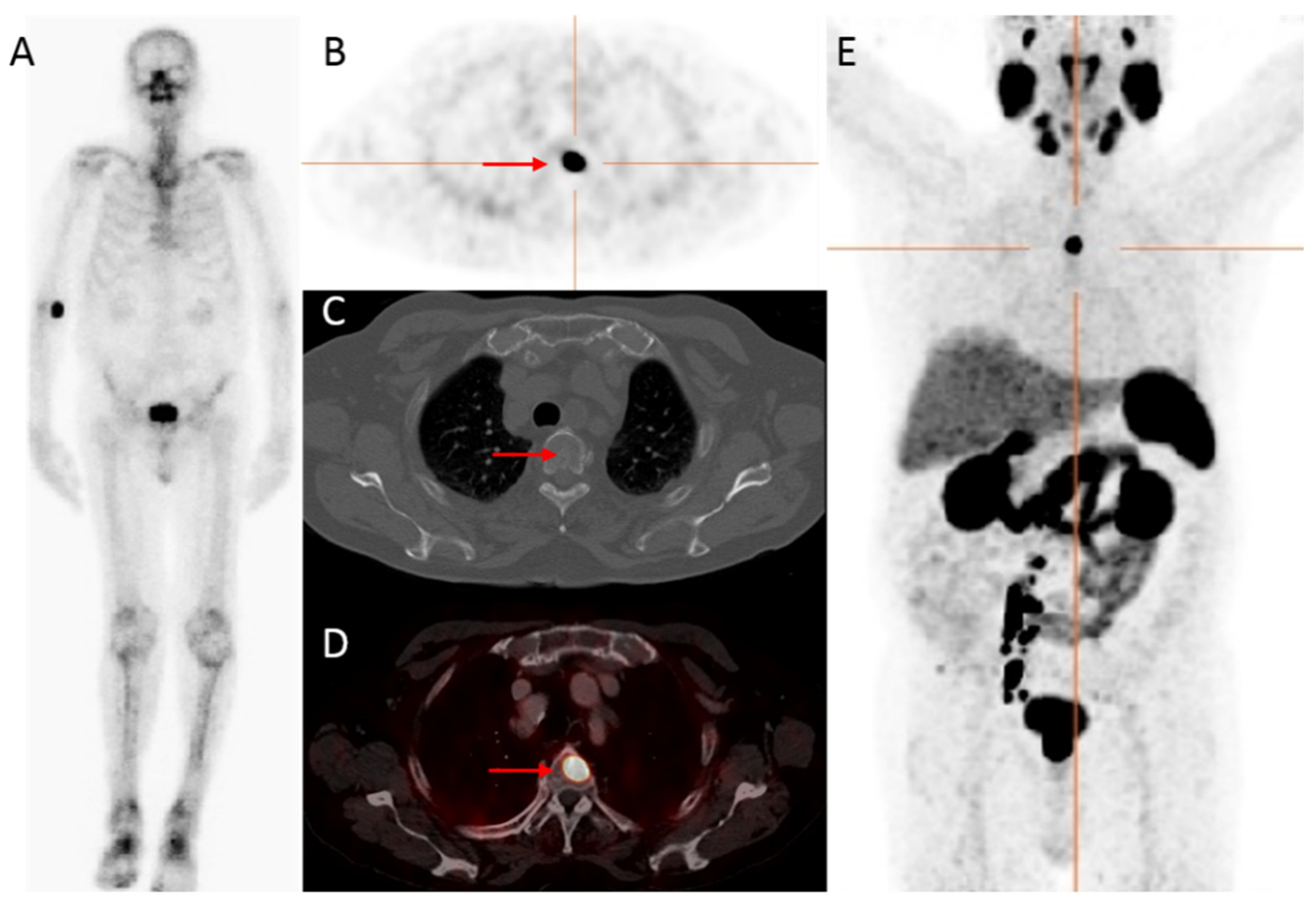 Prostate Cancer Nuclear Medicine Diagnostics