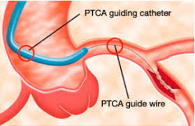 Ptca And Pta Balloon Catheter