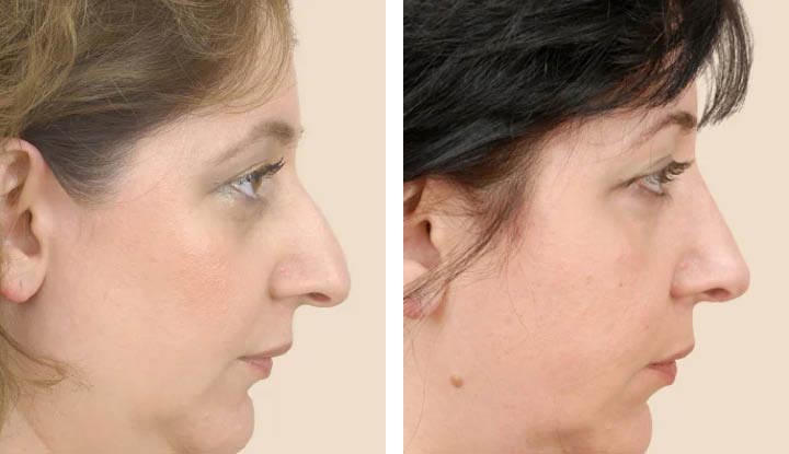 Rhinoplasty