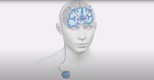 Deep Brain Stimulation Systems