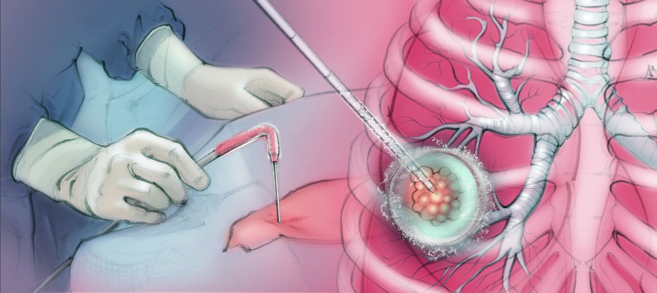 Tumor Ablation