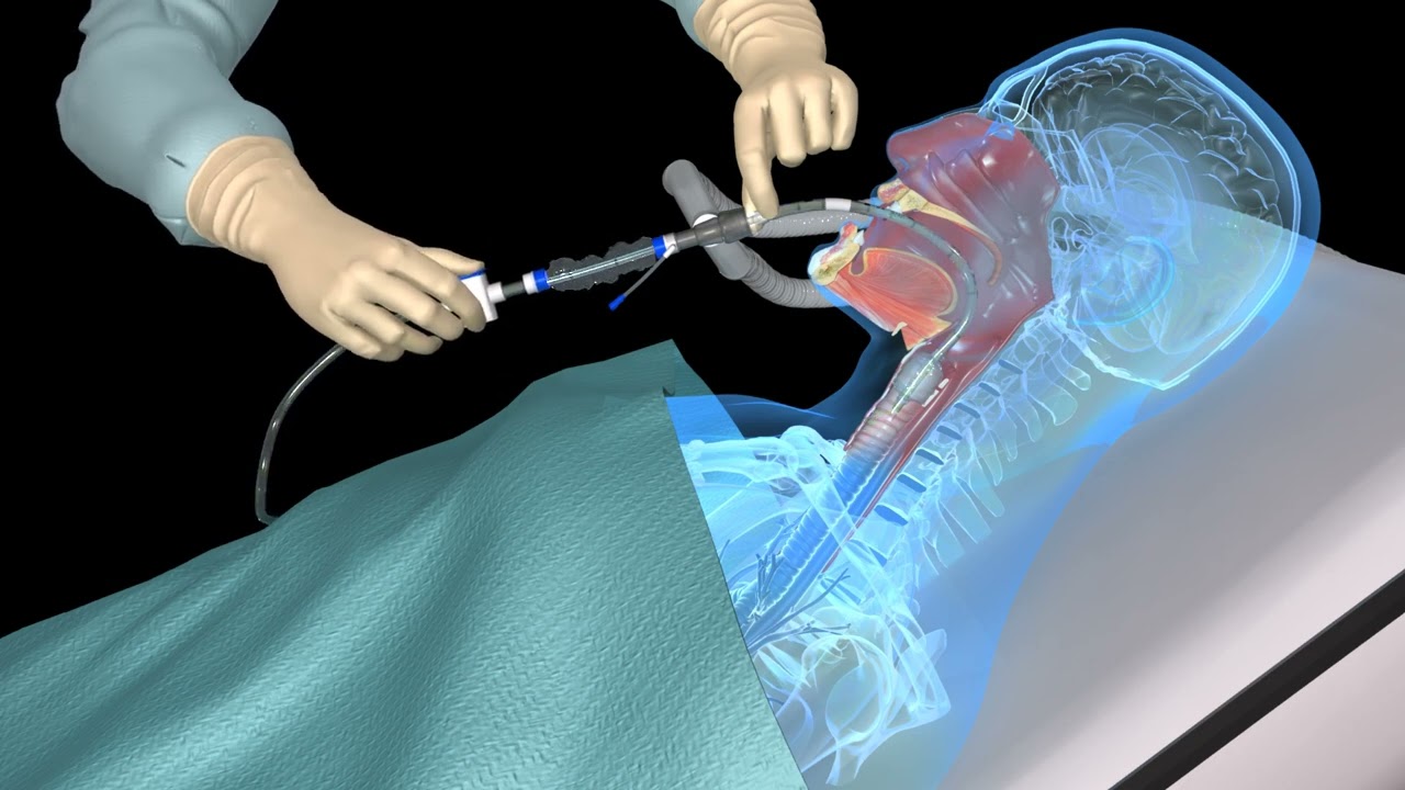 Endotracheal and Tracheal Suction