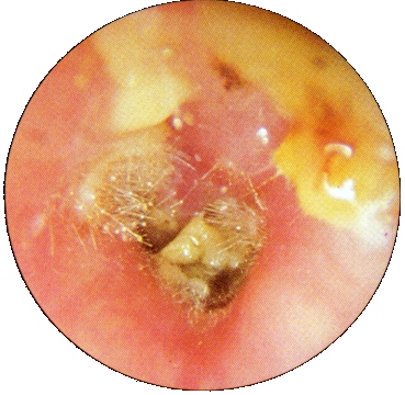 Fungal Otitis Externa