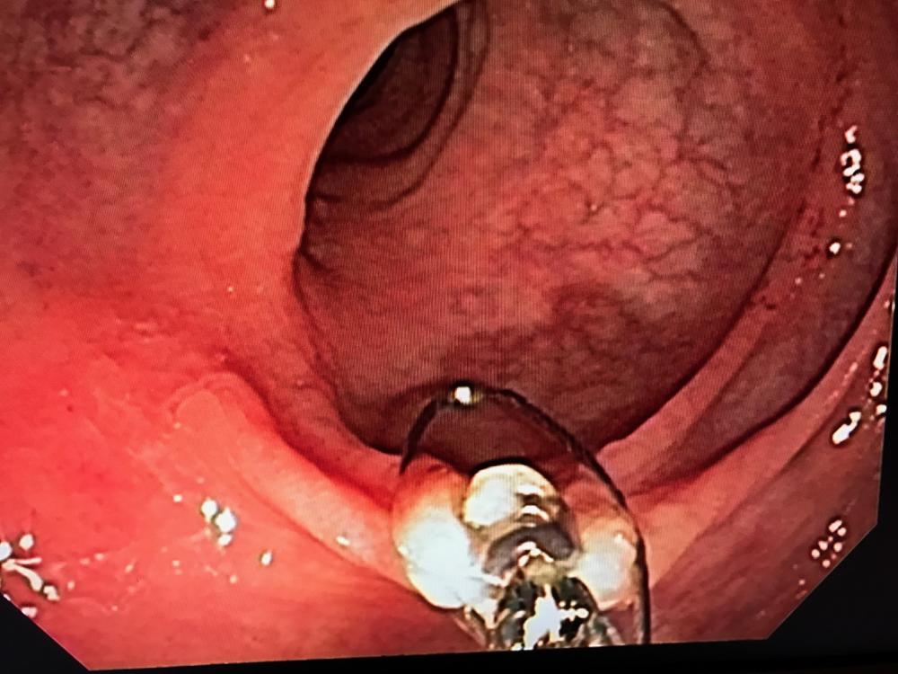 Intestinal Polyp Extraction Endoscopic