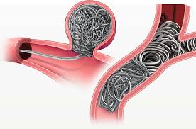 Intracranial Embolization Coil