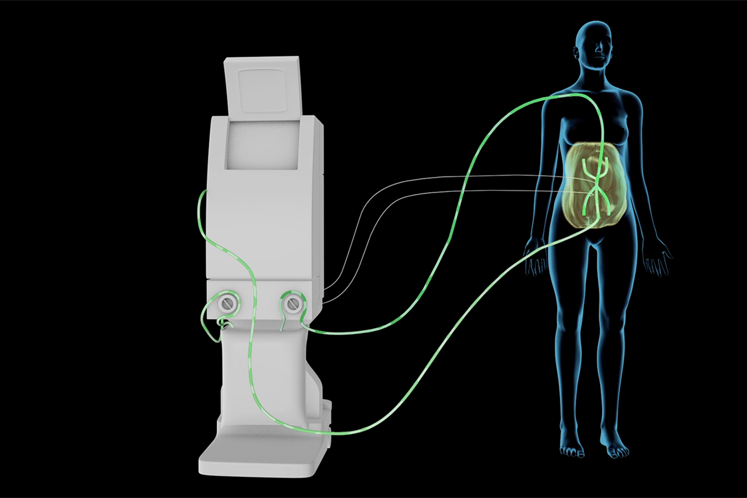 Peritoneal Hyperthermic Intraperitoneal Chemotherapy Machine