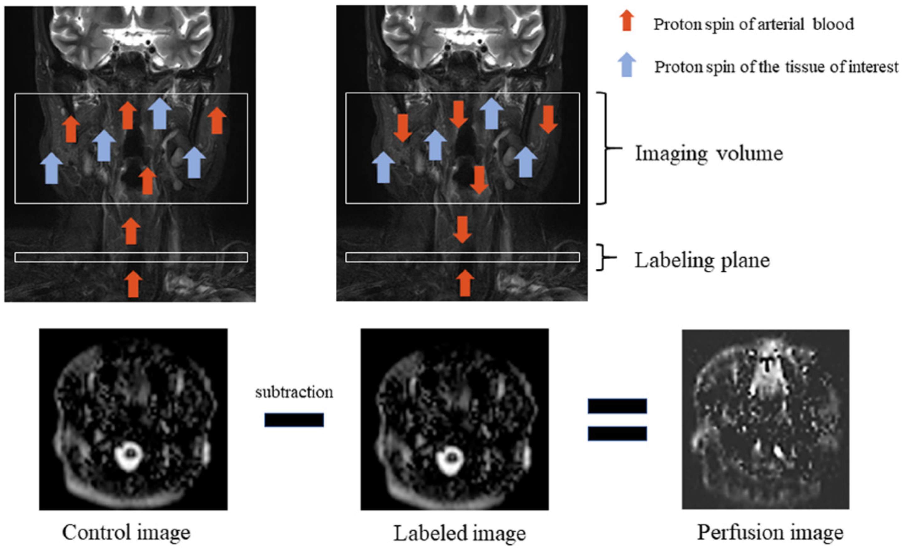 3D Arterial Spin Labeling