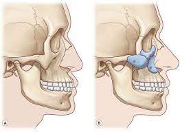 Aesthetic Facial Implants Market