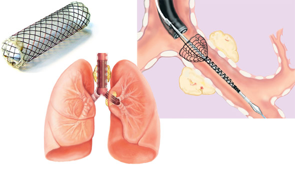 Airway (Lung Stent)