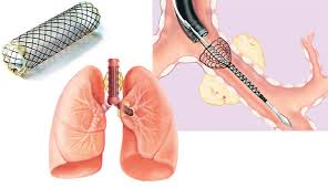 Airway and Lung Stent Market
