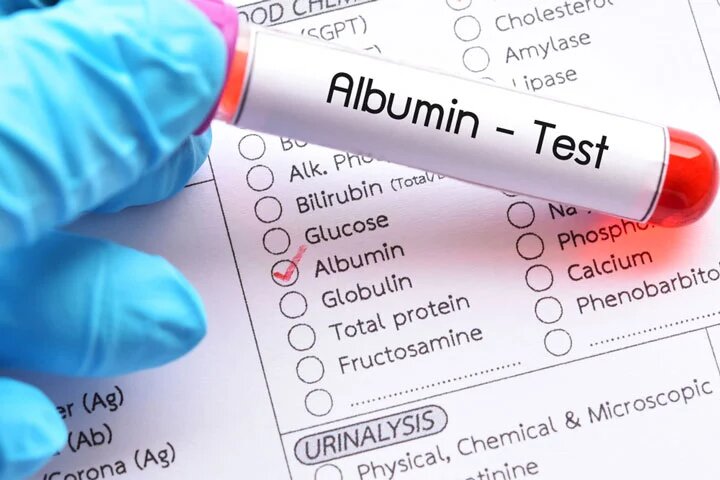 Albumin and Creatinine Test