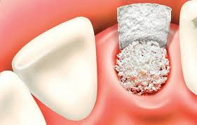 Allograft Bone Graft Substitute market