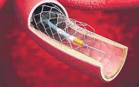 Anti-Restenosis Stents Market