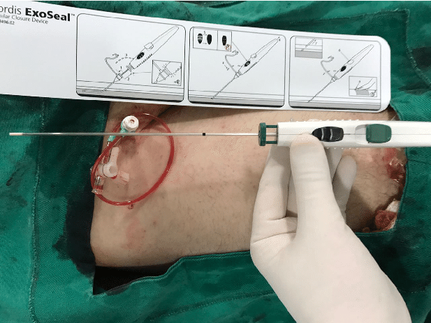 Arteriotomy Closure Devices