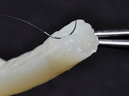 Artificial Nerve Grafts market