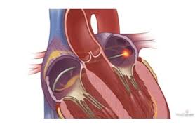 Atrial Fibrillation Catheter Ablation market