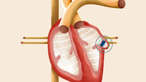 Atrial Fibrillation Devices market