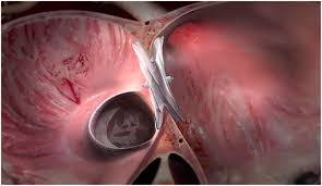 Atrial Septal Defect (ASD) Occluder Market