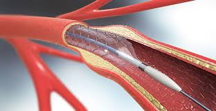 Bare Metal Stents