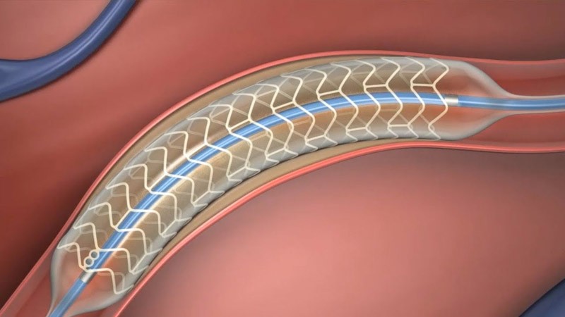 Bioabsorbable Coronary Stent